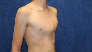 What Is Pectus Carinatum  Pigeon Chest  Fitness Duo [upl. by Ellehsor962]