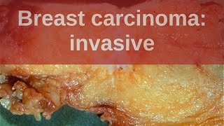 Breast Carcinoma Invasive  Pathology mini tutorial [upl. by Ynohta]