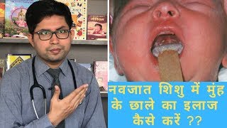 Oral candidiasis  Oral white patch  How to manage Oral thrush in baby  how to clean baby mouth [upl. by Konikow]