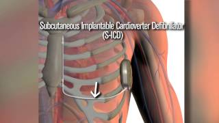 New SICD defibrillator a safety net for cardiac patients [upl. by Jerrilee629]