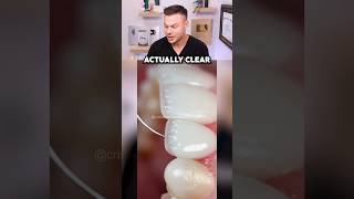 How to Get Veneers That DON’T Ruin Your Real Teeth [upl. by Silvano]