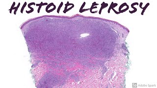 quotHistoidquot Lepromatous Leprosy Hansen disease [upl. by Ahtera970]