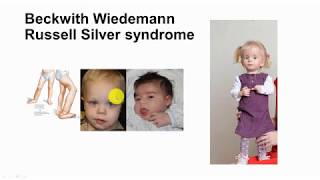 73 Imprinting part 2 Beckwith Wiedemann and Russell Silver syndrome [upl. by Neelyar]