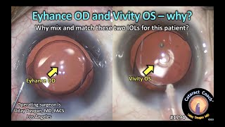 CataractCoach™1794 Eyhance Right Eye and Vivity Left Eye  Why [upl. by Earised260]