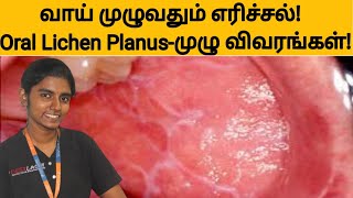 வாய் முழுவதும் எரிச்சல் Lichen Planusமுழு விவரங்கள்Teeth burning sensation causes and treatment [upl. by Maxma]