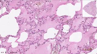 Pulmonary Edema  Histopathology [upl. by Humfrey235]