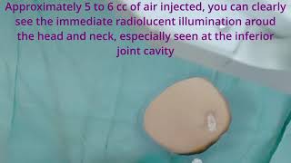 Hip Joint Air Arthrogram and Steroid Injection of the Hip Joint [upl. by Fatma]