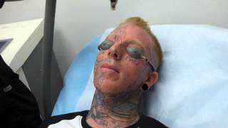 Incredible Face Tattoo Removal  3rd Treatment at Dr Tattoff [upl. by Kremer432]