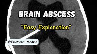 Brain abscess  CNS pathology  Robbins  emotionalmedico [upl. by Ines405]