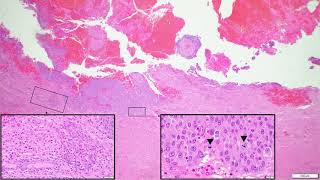 Carcinoma metastasis to brain  Adventures in Neuropathology [upl. by Nnayllehs]