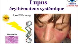 Lupus érythémateux Systémique Signes cliniques Biologiques physiopathologie [upl. by Leigha]