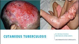 SKINCUTANEOUS TUBERCULOSIS BY DR ABRAHAM TB ulcers funny viralvideo education dermatology [upl. by Jonathan285]