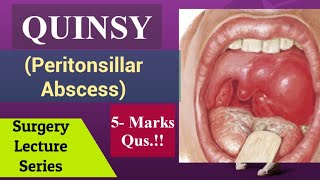 Peritonsillar AbscessQuinsy Surgery Lecture NEET PG Aspect in Tonsils Tonsillitis [upl. by Reace]