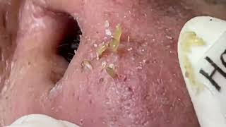 Blackhead removing at home 003 [upl. by Akedijn435]