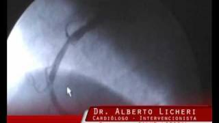 DR ALBERTO LICHERI  STENT COLOCACIÓN SANTA FE  ARGENTINA [upl. by Lahcim]