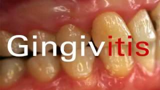 why bleeding gums  what is Gingivitis [upl. by Lancelle]