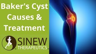 Bakers Cyst Causes and Treatment [upl. by Duthie145]