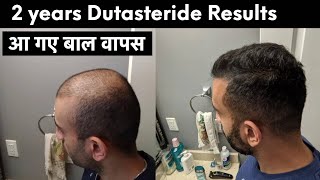 Shocking 2 Years Dutasteride  Minoxidil  RU58841  Nizoral Shampoo Results [upl. by Yesnnyl]