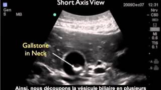 Comment  Réaliser une échographie de la vésicule biliaire  Partie 2  Calculs biliaires [upl. by Fernandina]