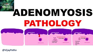 ADENOMYOSIS  Pathology Clinical Features Diagnosis amp treatment [upl. by Ahsiaa360]