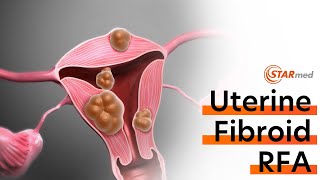 Uterine Fibroid Radiofrequency AblationRFA Procedure [upl. by Naleag]