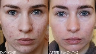 ROACCUTANE MONTH 6  Update amp Daily Skin Vlog [upl. by Kania]