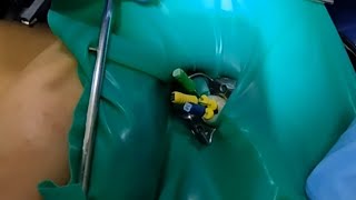 Endodoncia en un Primer molar superior derecho Pz 16 [upl. by Karilla]