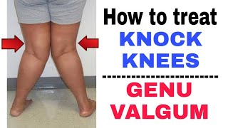 How to fix Knock kneesGenu valgum  Knock knees exercises at home  Dr Pratibha Singh PT [upl. by Junette]