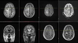 T2 hypointense lesion in brain with peripheral enhancement query tuberculoma [upl. by Eenad]