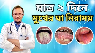 মুখের ঘা দূর করার উপায়mukhe gha hole ki korboমুখে ঘা হলে কি করবেনমুখের ঘা সারানোর উপায় [upl. by Ronnie]