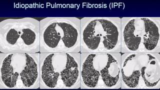 CHEST 2016 video sessions HRCT of the chest [upl. by Edla]