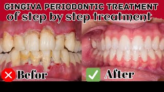 Do You Have Gingivitis or Periodontitis  Different Stages Of Gum Disease [upl. by Adnoryt11]