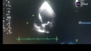 HYPOKINESIA OF ANTERO SEPTUM APICAL SEPTUM AND APEX MODERATE TO SEVERE LV MILD MR [upl. by Rhtaeh]