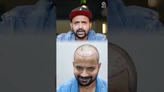 Youtuber Topa Bhai  Nadeem Bunny  Hair Transplant Journey  Before and After Surgery shorts [upl. by Aicrop]