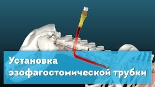 Установка эзофагостомической трубки Esophagostomy Tube Placement [upl. by Ainav561]