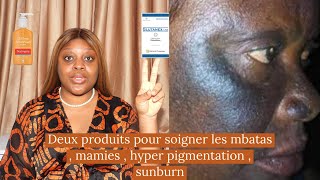 Comment guérir et éviter les brûlures du visage les mbatas  sunburn  mamies  les discolorations [upl. by Rosmarin131]