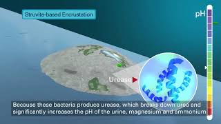 Tria Ureteral Stents – Struvite Encrustation [upl. by Stillmann]