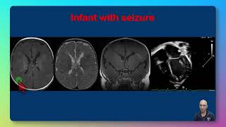 Tuberous Sclerosis [upl. by Philan]