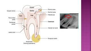 Diseases of pulp and periapical area [upl. by Sammons125]