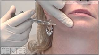 NonSurgical Jowl and Jawline Lift  Dr Babak Azizzadeh in Beverly Hills [upl. by Ahsemac]