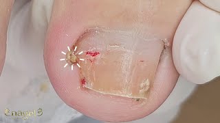 😖INÍCIO DE UMA INFLAMAÇÃO EM PACIENTE DIABÉTICA nails ingrowntoenail [upl. by Ajnos261]