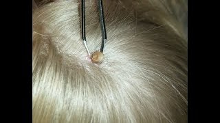 Removing a tick from my childs head [upl. by Schroth]