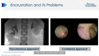 Stent Encrustation Discoloration and Patient Tolerability [upl. by Pesek]