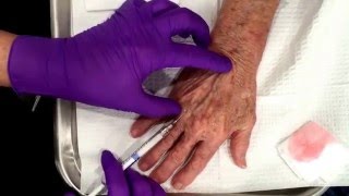 Hand Rejuvenation with MicroCannula technique Radiesse® [upl. by Eivets879]