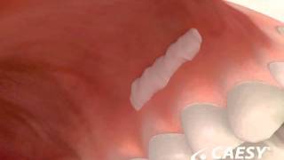 Periodontal Disease Surgery Free Gingival Graft [upl. by Esele]