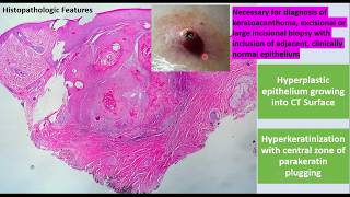 Keratoacanthoma EVERYTHING you need to know  Etiologyclinical featuresHistopathTreatment [upl. by Eimar454]