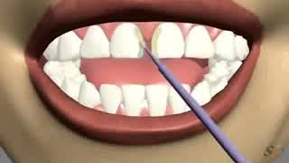 gap closure by dental veneers [upl. by December]