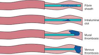 PICC line IV flush [upl. by Griffiths]