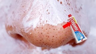 FIRST TIME USING Colgate to Remove Blackheads amp Whiteheads From Your Nose  REMOVES EVERYTHING [upl. by Misa]