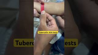 Tuberculin skin tests TST mediciane education baby MedicoAS [upl. by Berthe]